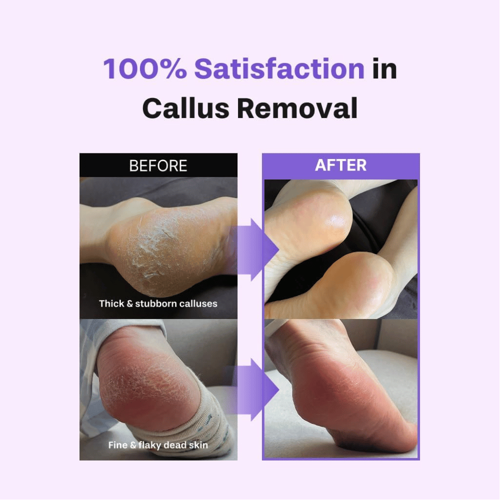 Before and after using BAREN Foot Callus Eraser Home Set on dry feet, dead skin, and calluses
