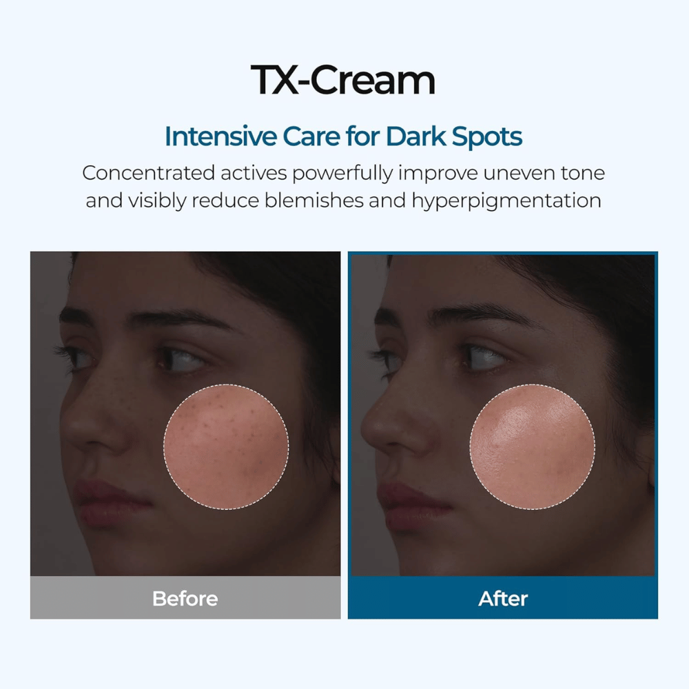 Before and after results with TX Cream that reduces dark spots and uneven skin tone for visibly clearer and more even skin