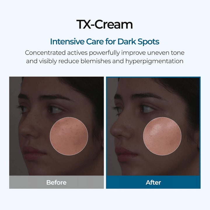 Before and after results with TX Cream that reduces dark spots and uneven skin tone for visibly clearer and more even skin